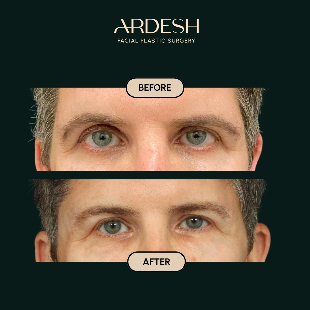 Procedure before and after - after