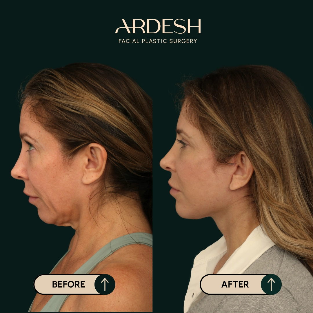 Procedure before and after - after
