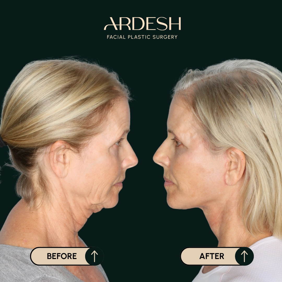Procedure before and after - after