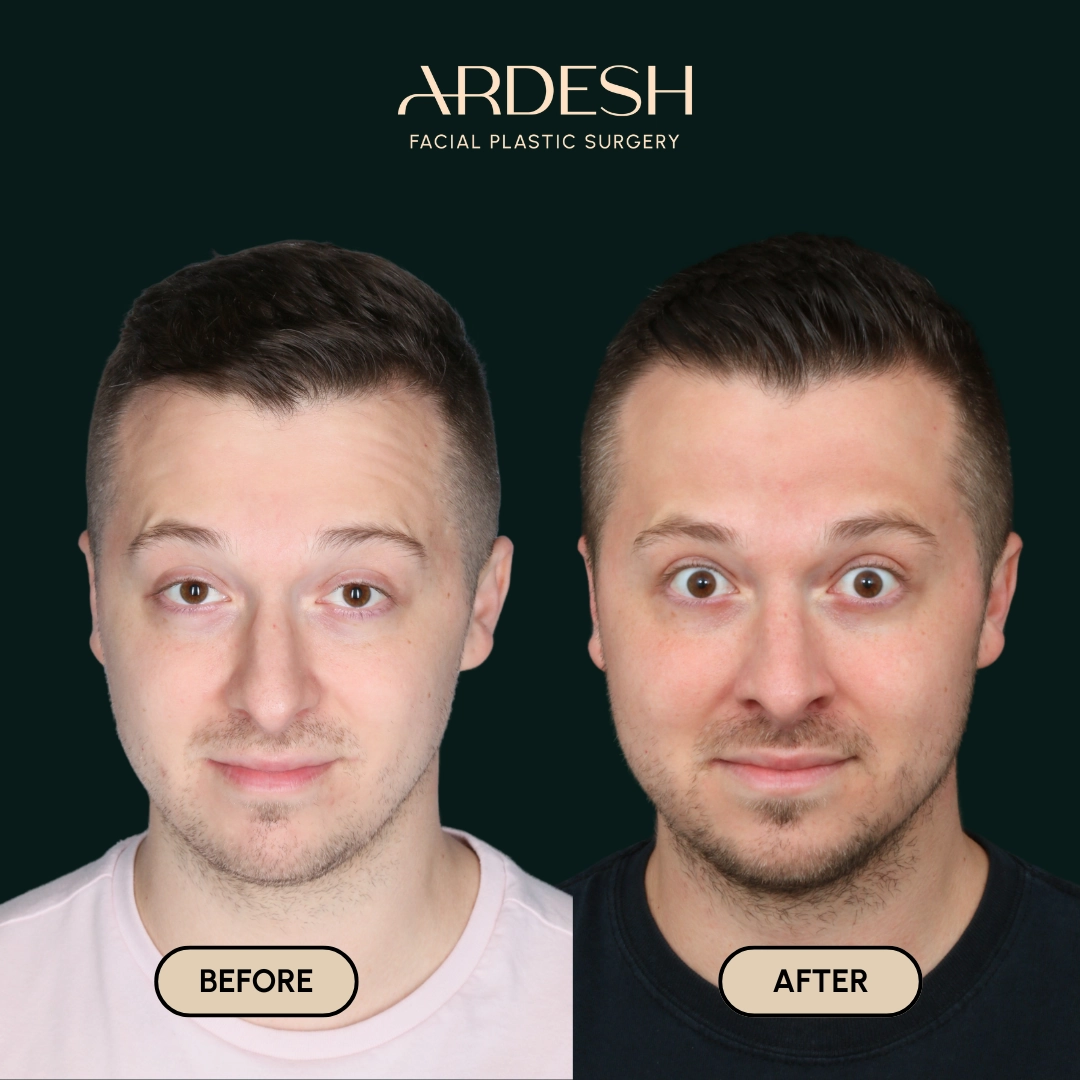 Procedure before and after - after
