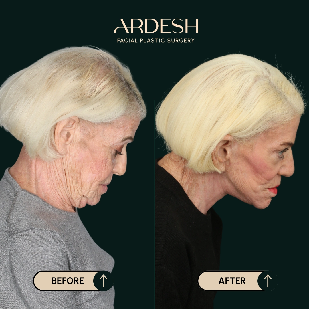 Procedure before and after - after