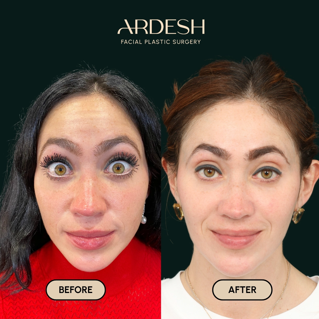 Procedure before and after - after