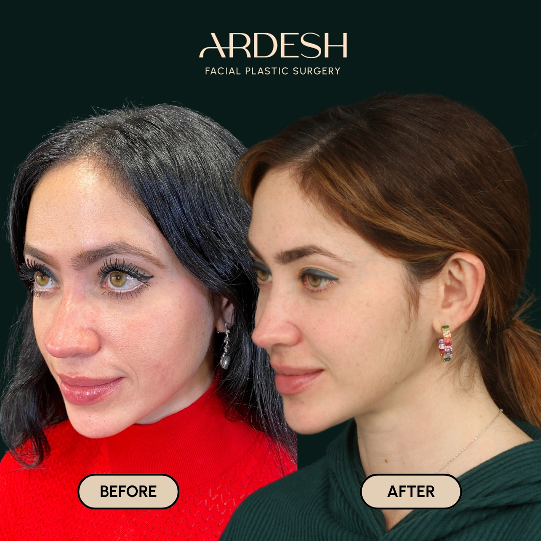Other procedures by Dr. Farhad Ardeshirpour-Zartoshti — before and after