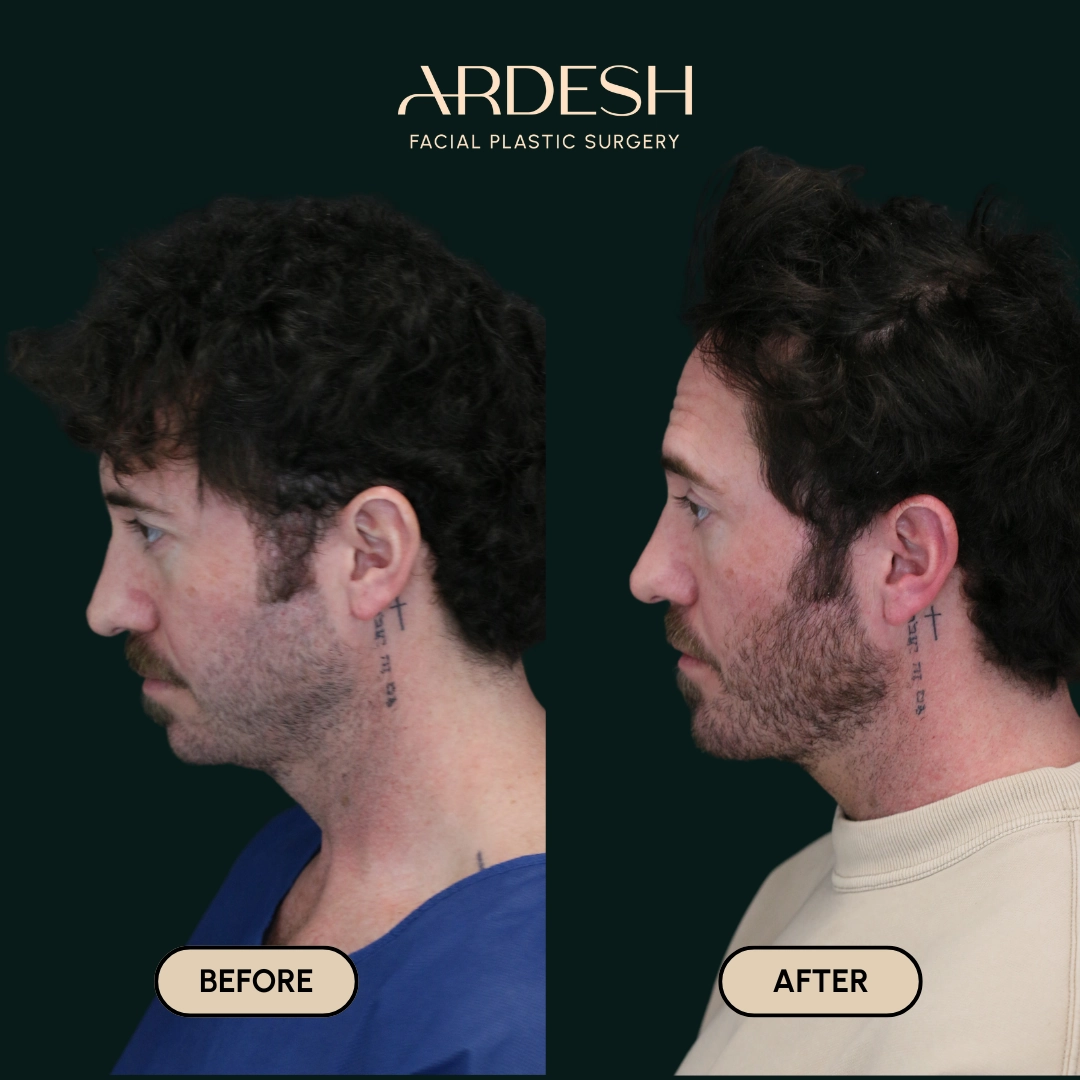 Other procedures by Dr. Farhad Ardeshirpour-Zartoshti — before and after