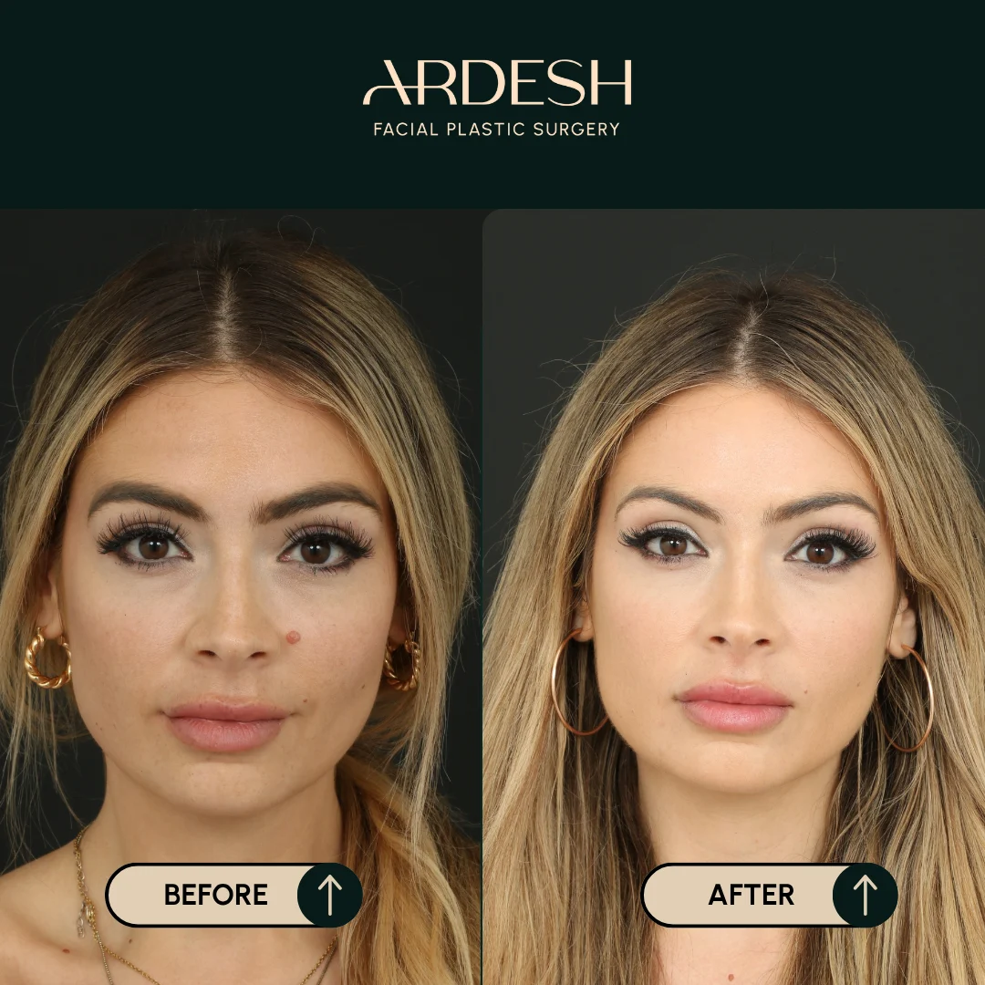 Other procedures by Dr. Farhad Ardeshirpour-Zartoshti — before and after