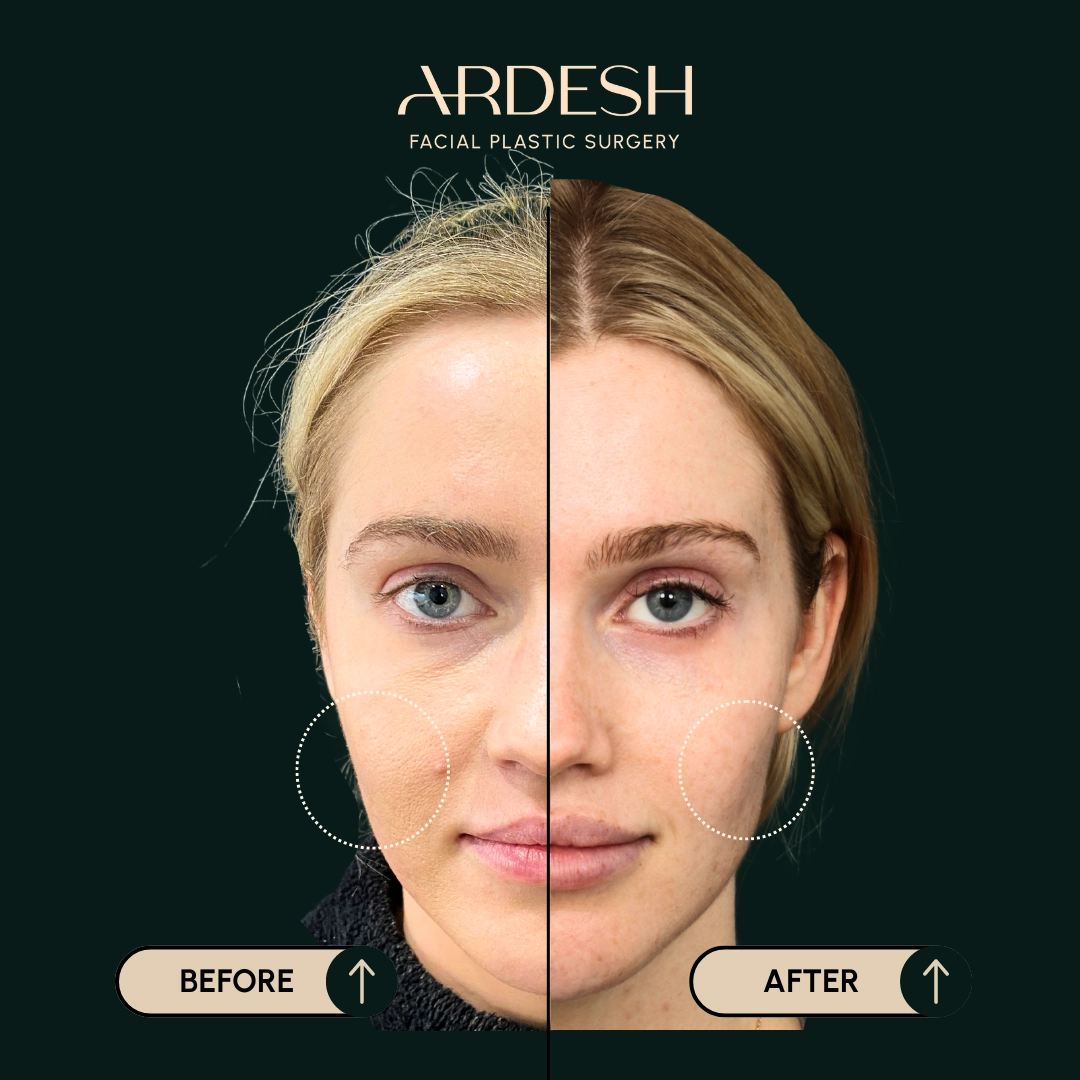 Other procedures by Dr. Farhad Ardeshirpour-Zartoshti — before and after