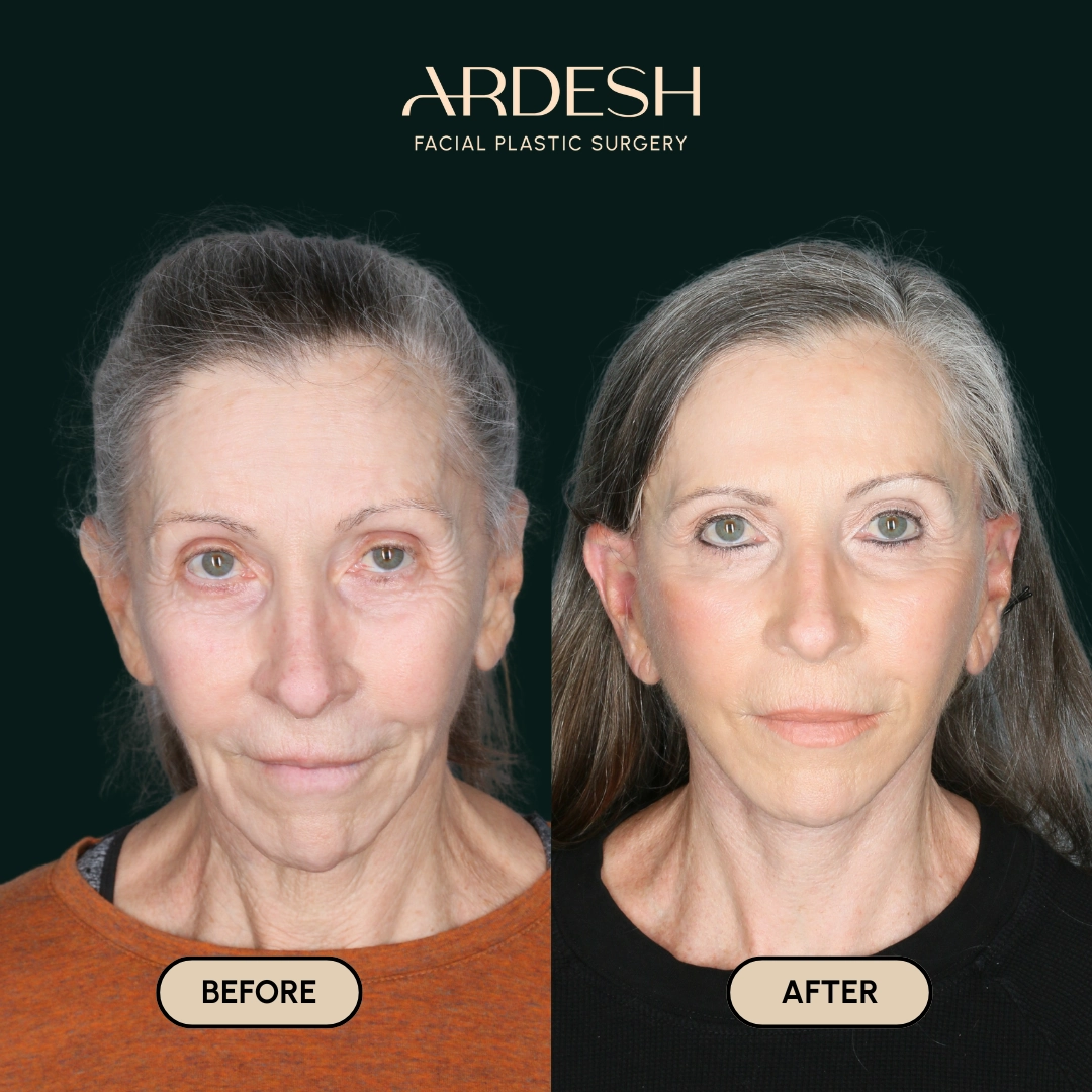 Other procedures by Dr. Farhad Ardeshirpour-Zartoshti — before and after
