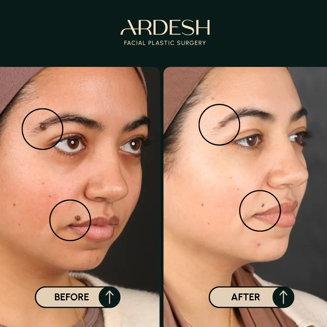 Other procedures by Dr. Farhad Ardeshirpour-Zartoshti — before and after