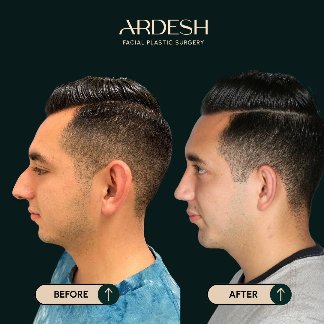 Other procedures by Dr. Farhad Ardeshirpour-Zartoshti — before and after
