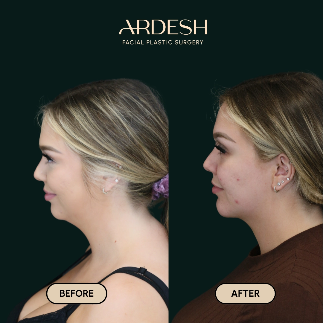 Other procedures by Dr. Farhad Ardeshirpour-Zartoshti — before and after