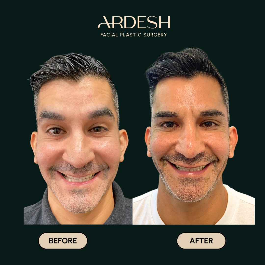 Other procedures by Dr. Farhad Ardeshirpour-Zartoshti — before and after