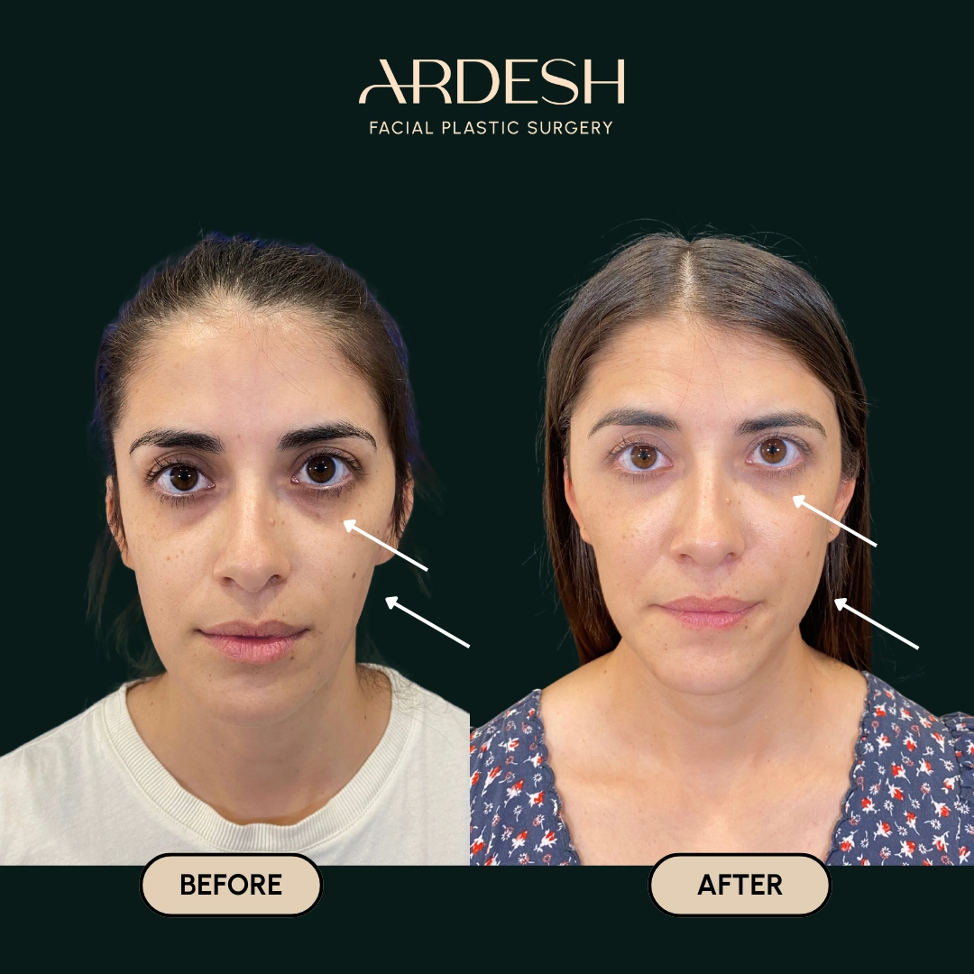 Other procedures by Dr. Farhad Ardeshirpour-Zartoshti — before and after