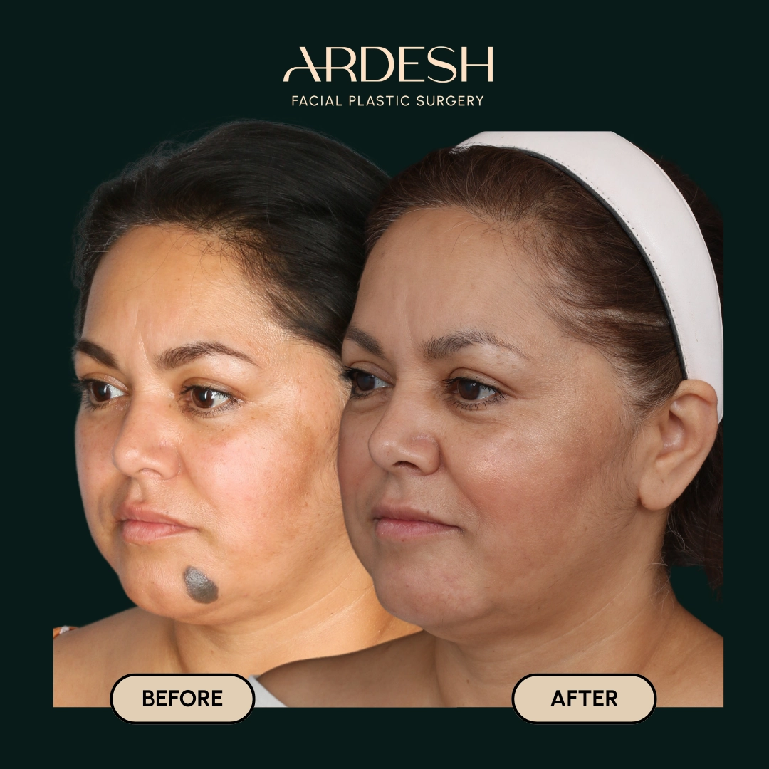 Other procedures by Dr. Farhad Ardeshirpour-Zartoshti — before and after