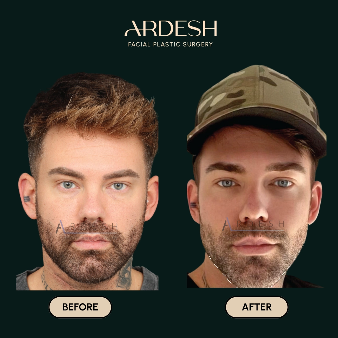 Other procedures by Dr. Farhad Ardeshirpour-Zartoshti — before and after