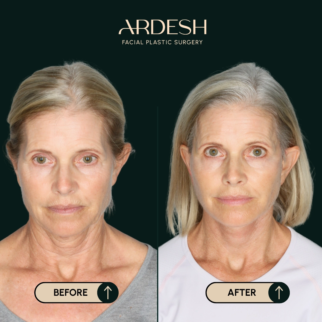 Other procedures by Dr. Farhad Ardeshirpour-Zartoshti — before and after