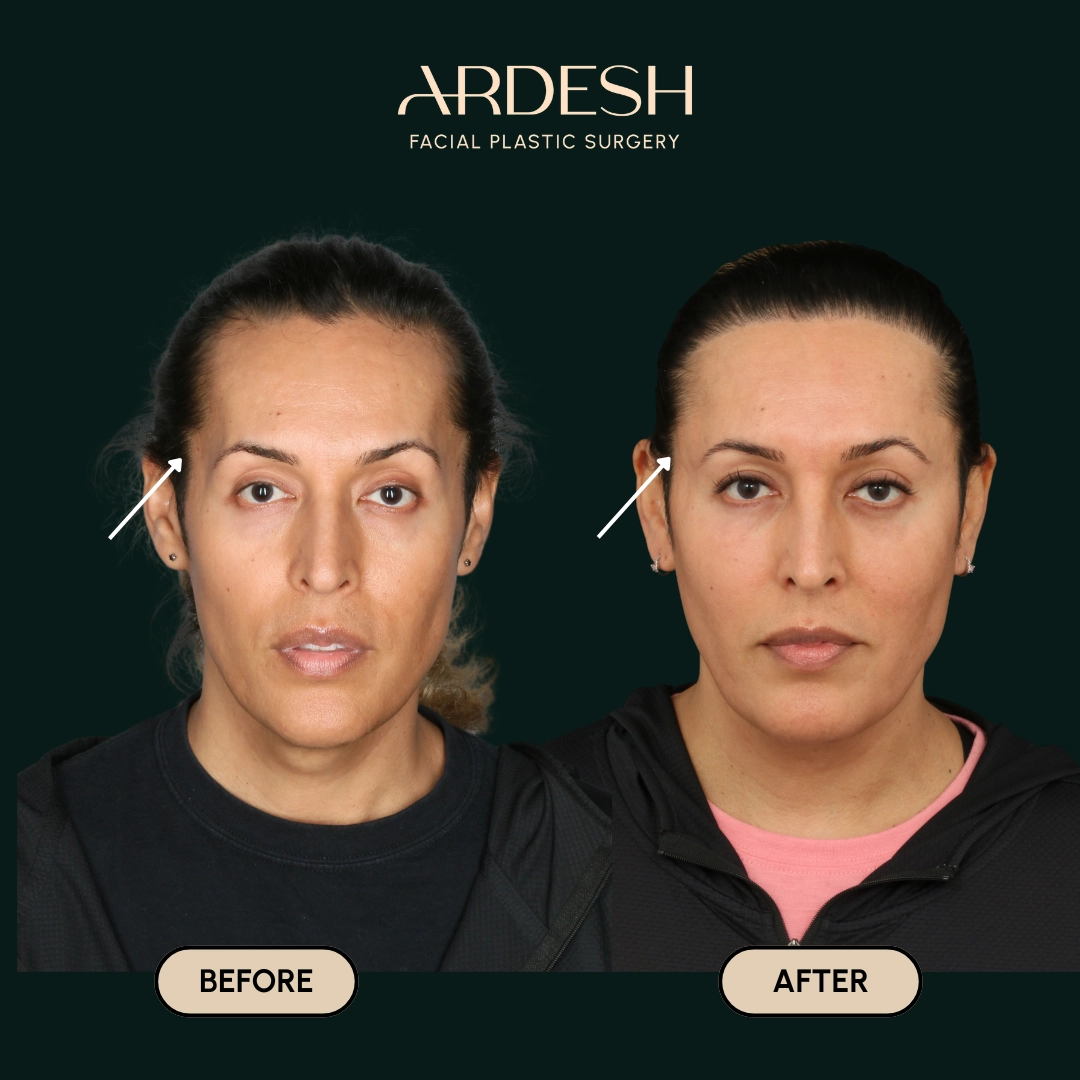 Other procedures by Dr. Farhad Ardeshirpour-Zartoshti — before and after