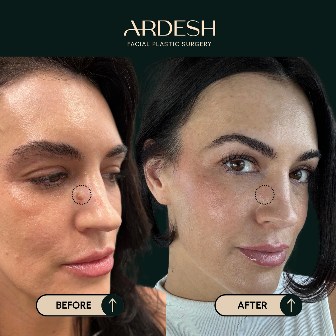 Other procedures by Dr. Farhad Ardeshirpour-Zartoshti — before and after