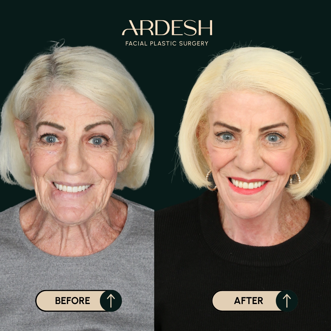 Other procedures by Dr. Farhad Ardeshirpour-Zartoshti — before and after