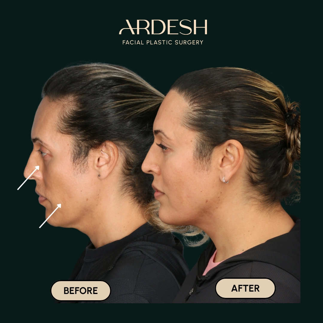 Other procedures by Dr. Farhad Ardeshirpour-Zartoshti — before and after