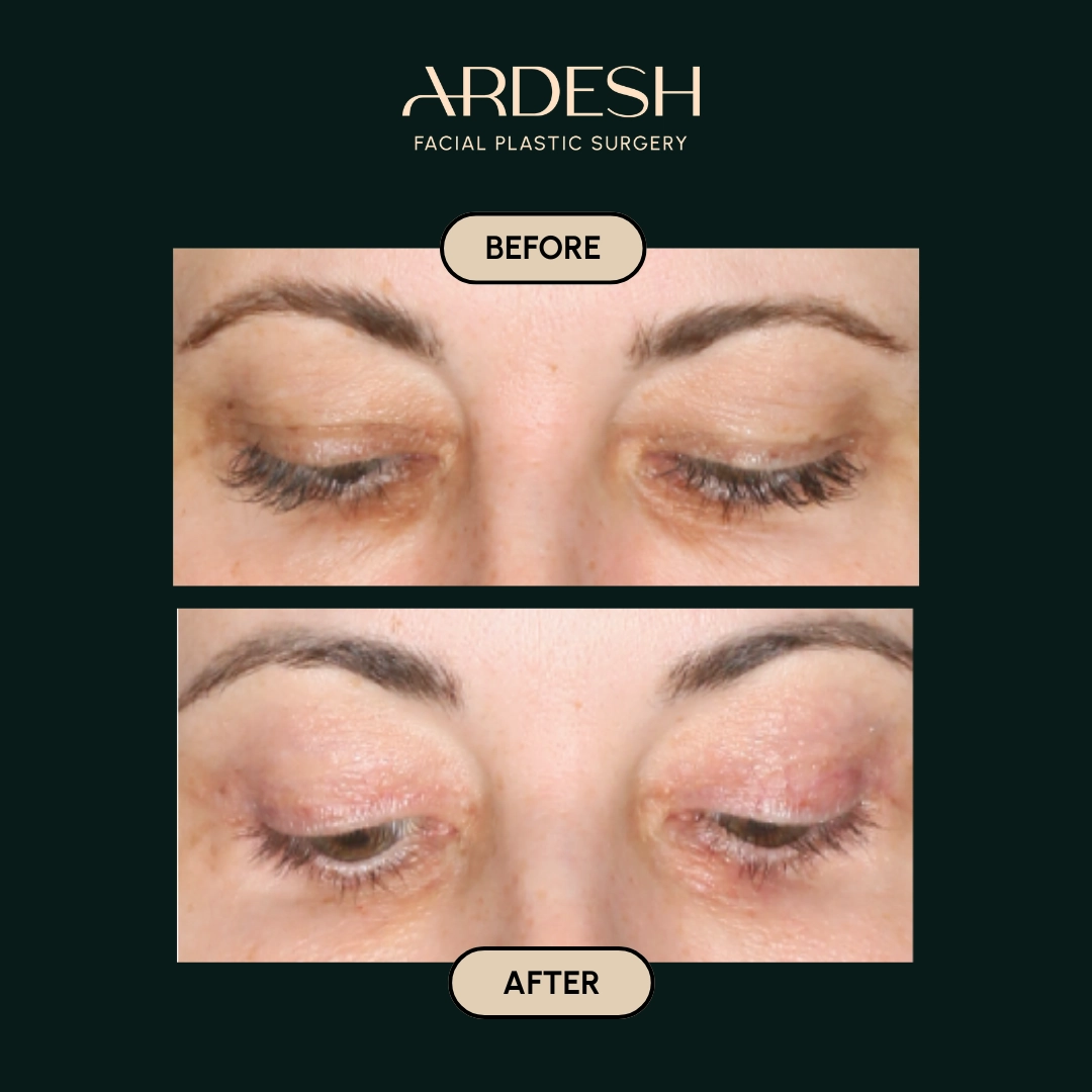 Other procedures by Dr. Farhad Ardeshirpour-Zartoshti — before and after