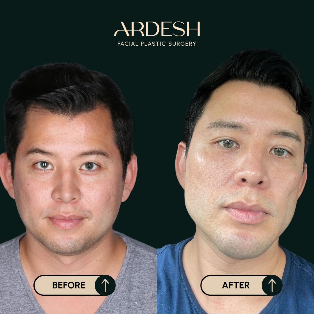 Other procedures by Dr. Farhad Ardeshirpour-Zartoshti — before and after