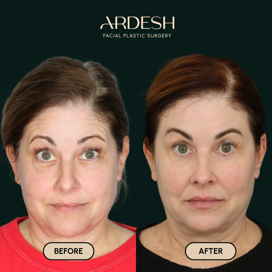 Other procedures by Dr. Farhad Ardeshirpour-Zartoshti — before and after