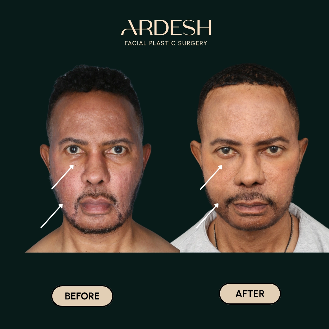 Other procedures by Dr. Farhad Ardeshirpour-Zartoshti — before and after