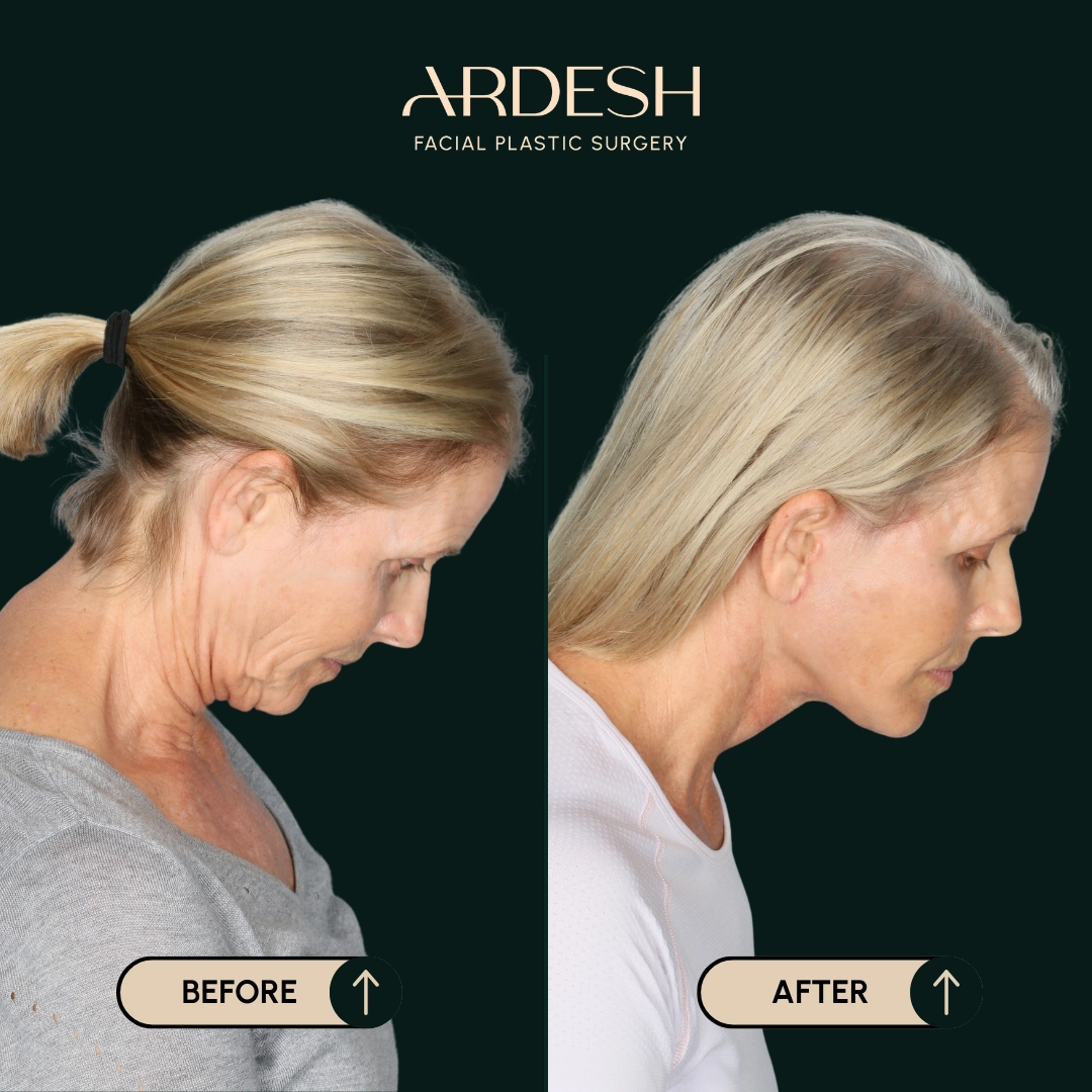 Other procedures by Dr. Farhad Ardeshirpour-Zartoshti — before and after