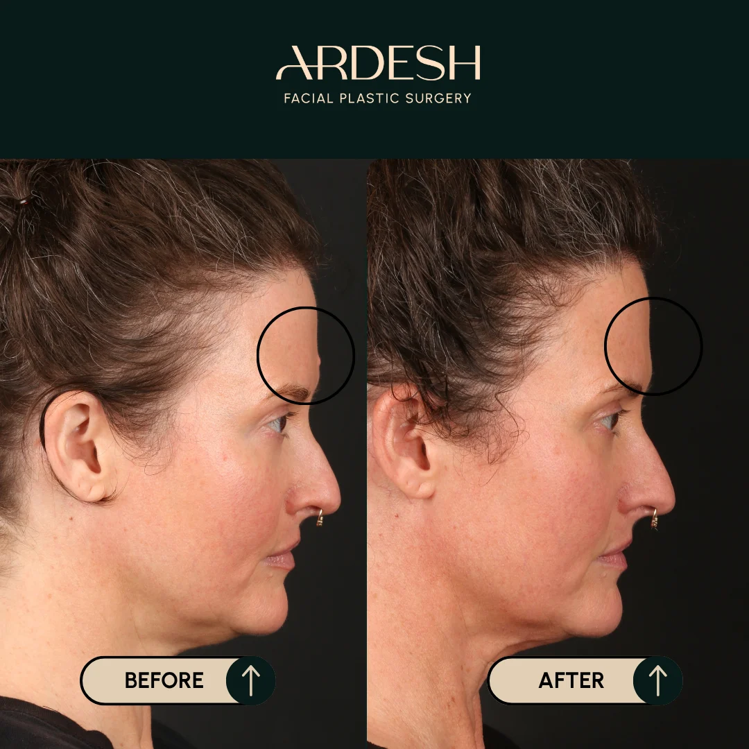 Other procedures by Dr. Farhad Ardeshirpour-Zartoshti — before and after