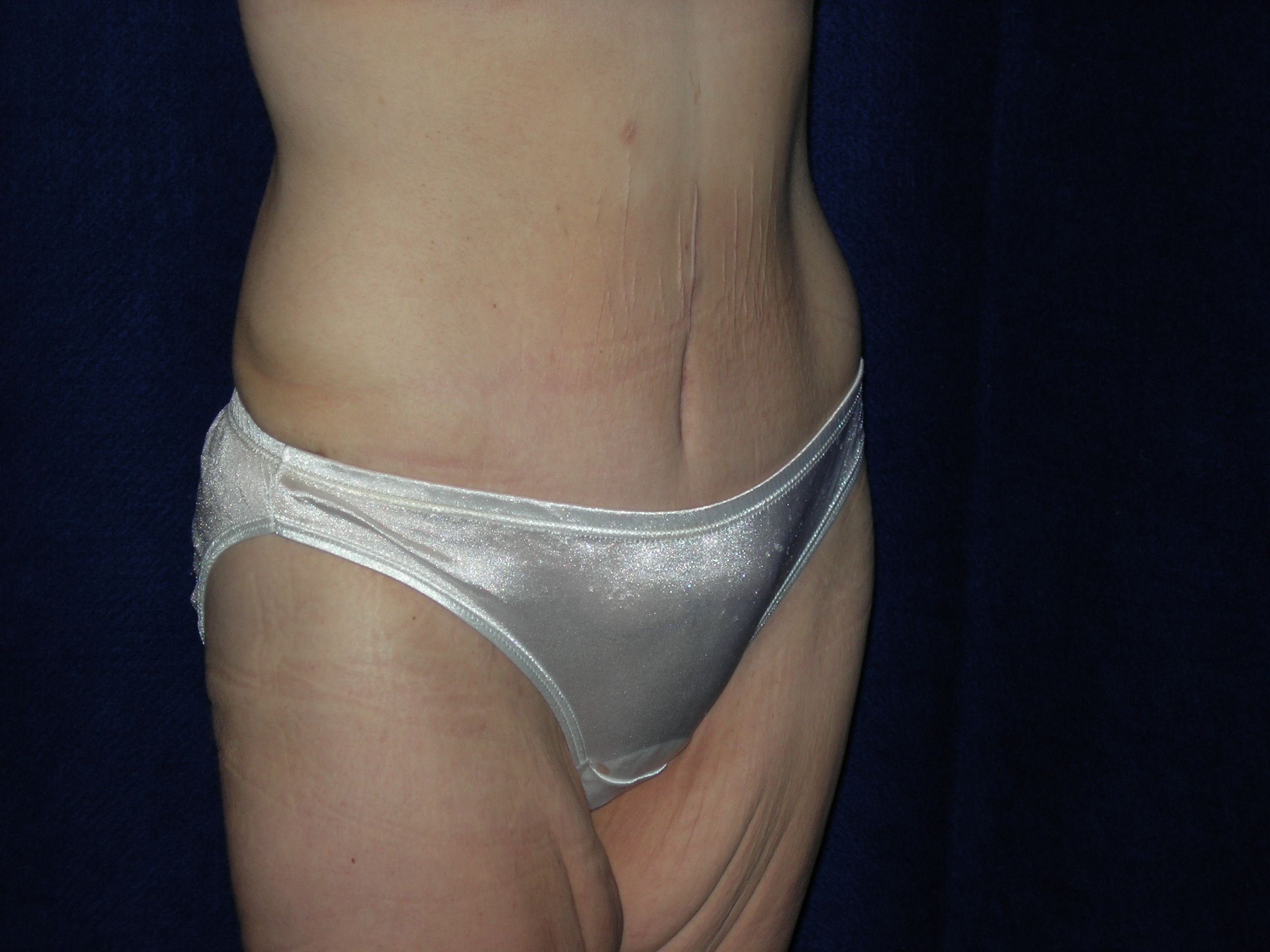 MWL Abdominoplasty before and after - after