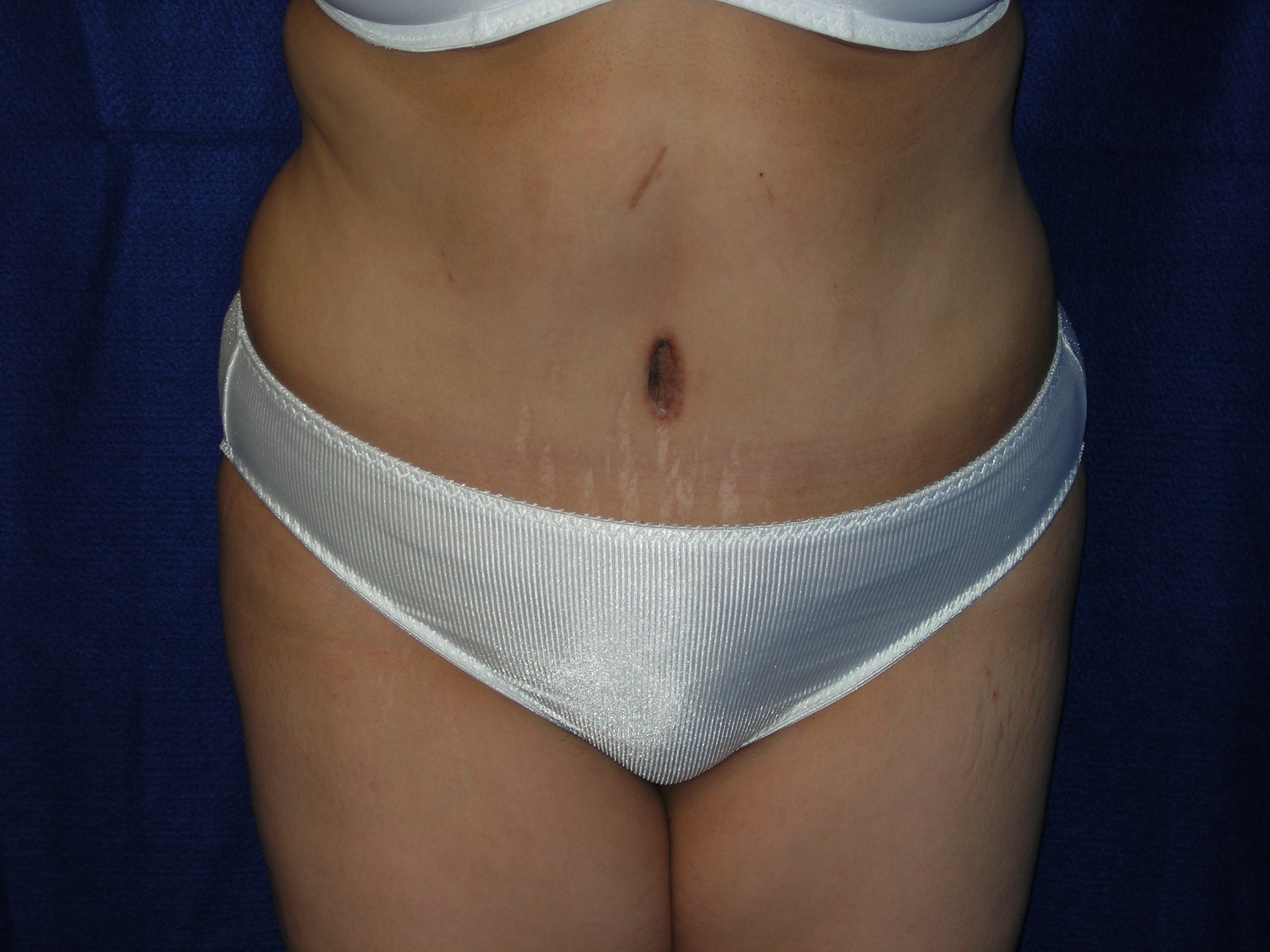 Abdominoplasty before and after - after