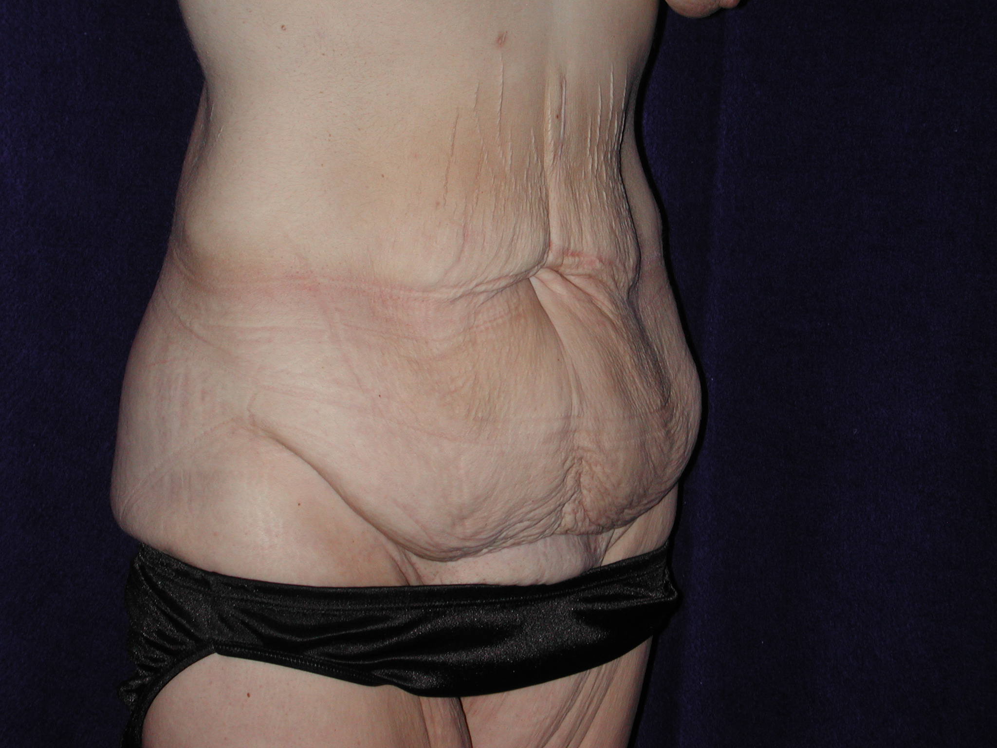 MWL Abdominoplasty before and after - before