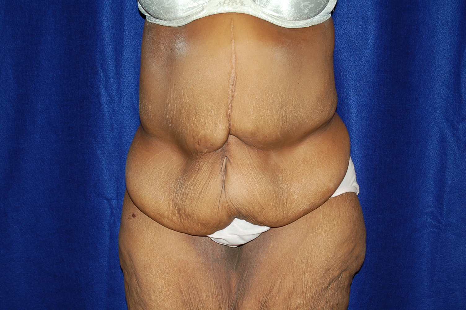 MWL Abdominoplasty before and after - before