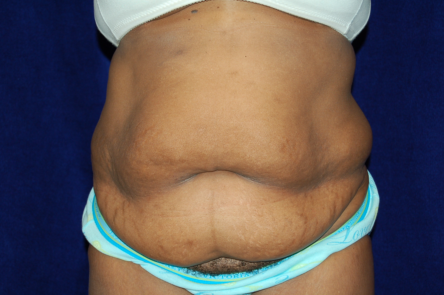 Abdominoplasty before and after - before