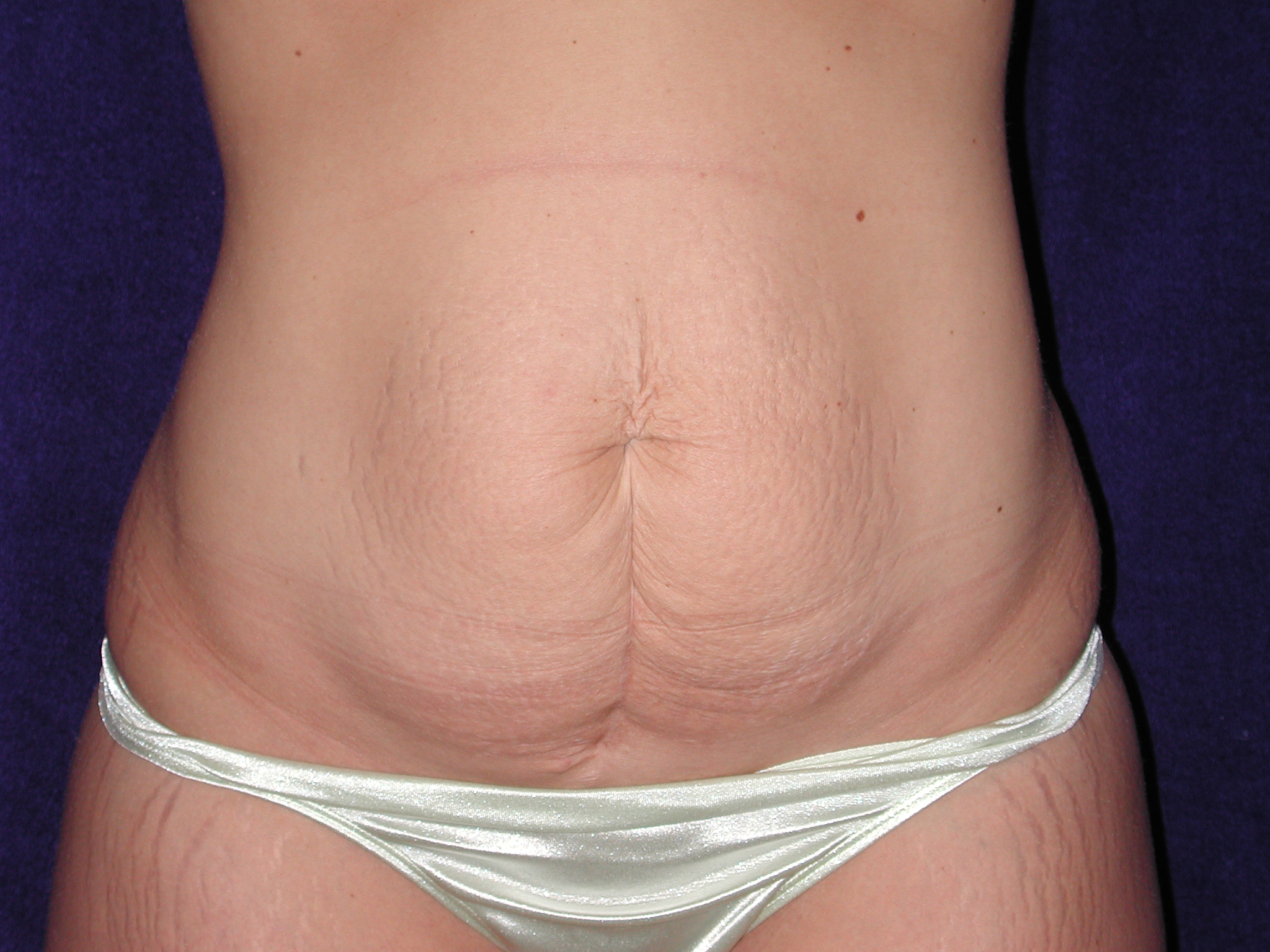 Abdominoplasty before and after - before
