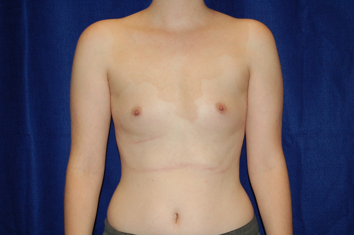 Breast Augmentation before and after - before