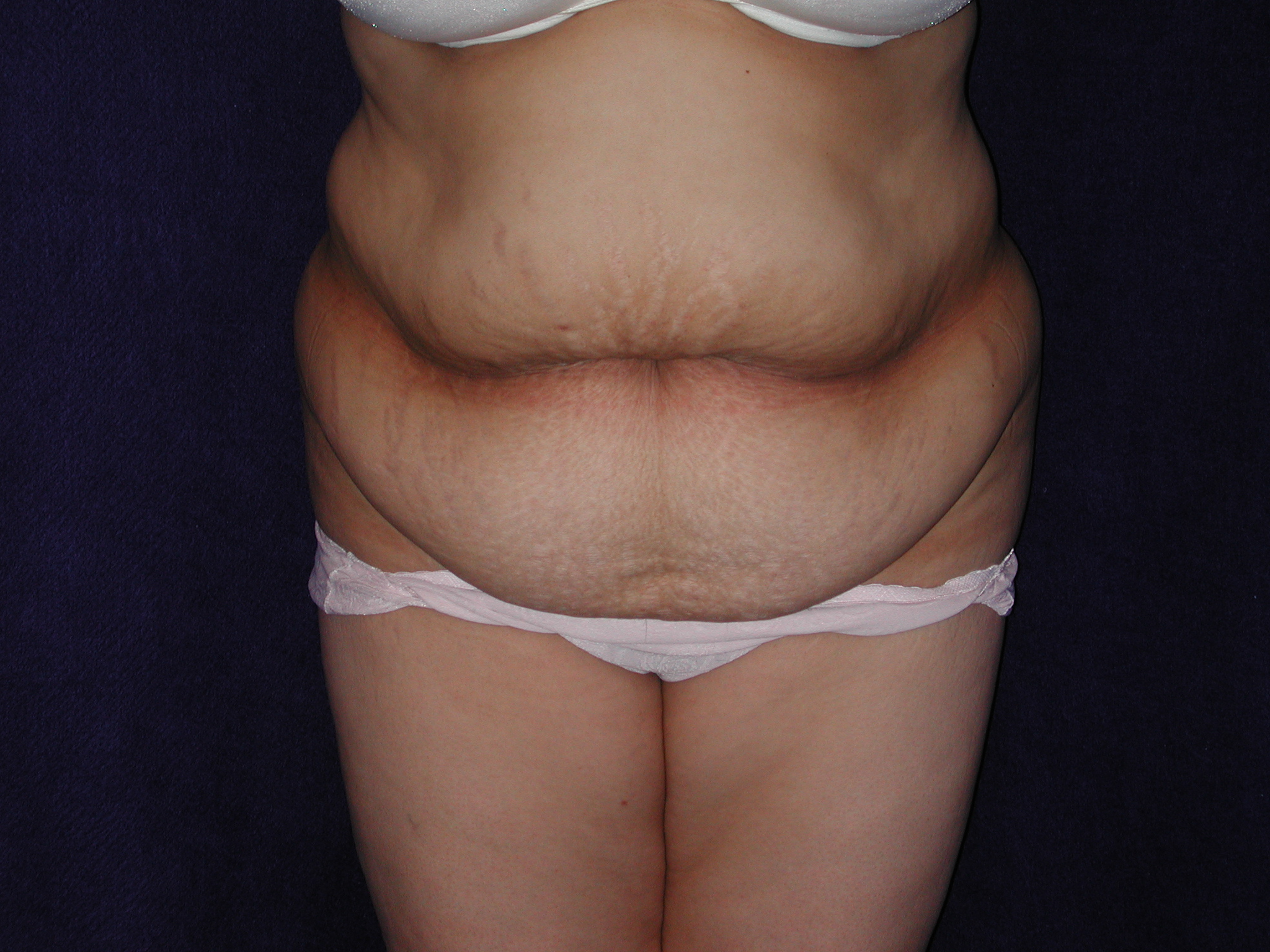 Abdominoplasty before and after - before
