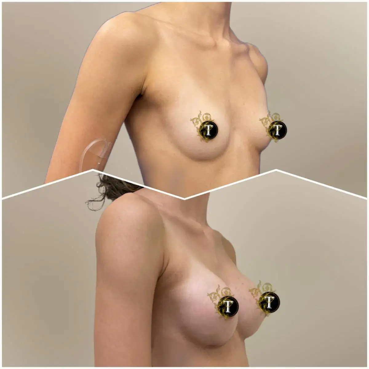 Breast Augmentation by Dr. Victoria Tran — after