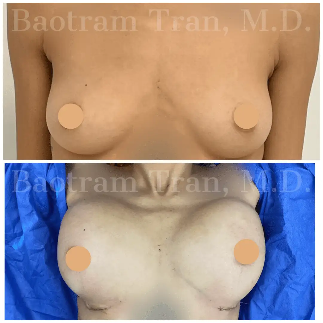 Breast Augmentation by Dr. Victoria Tran — after