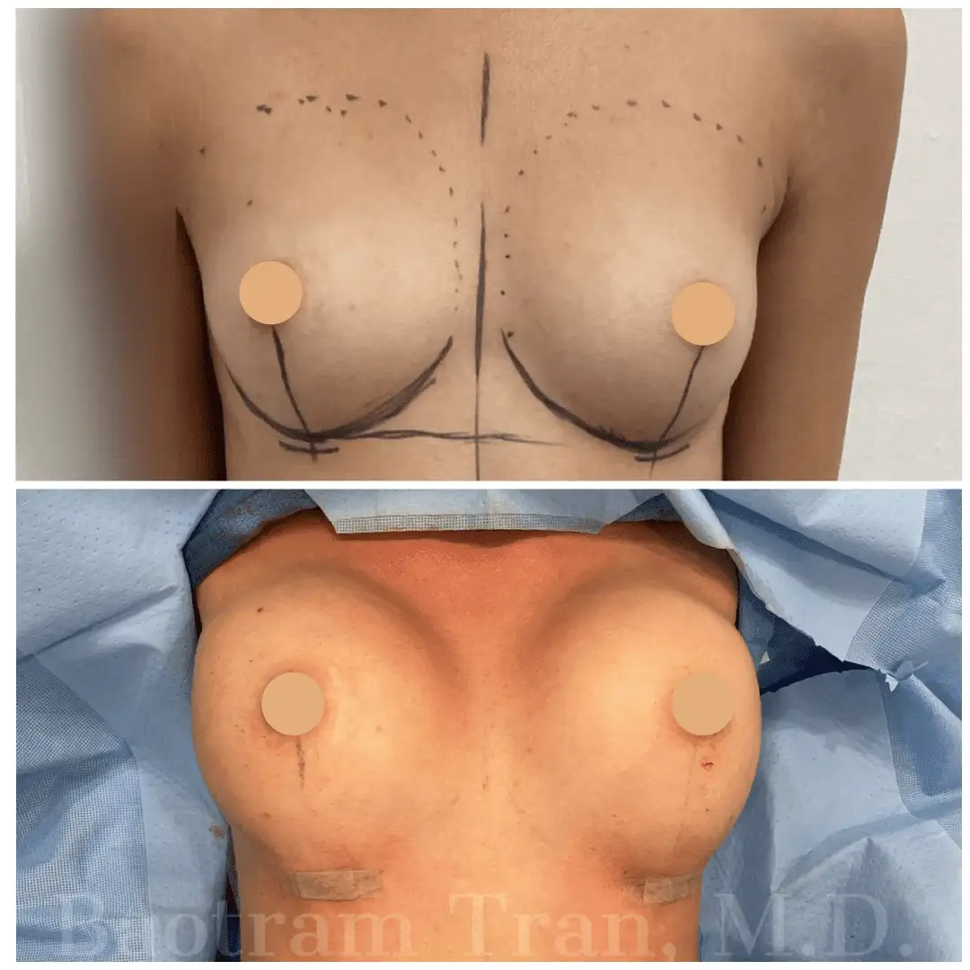 Breast Augmentation by Dr. Victoria Tran — after