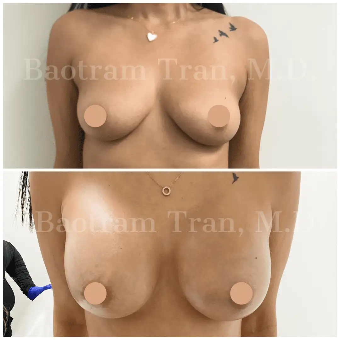 Breast Augmentation by Dr. Victoria Tran — before