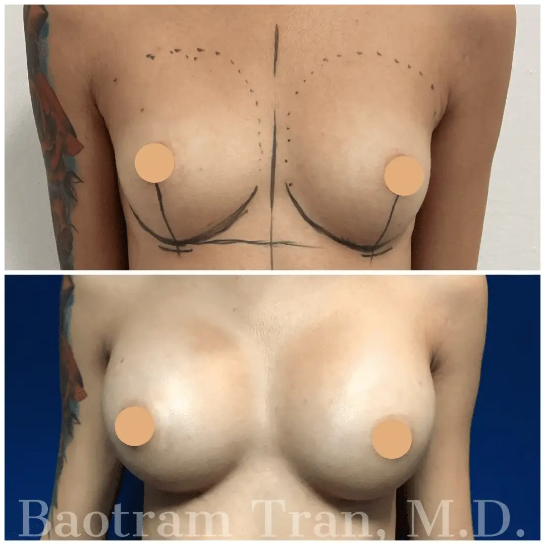 Breast Augmentation by Dr. Victoria Tran — before