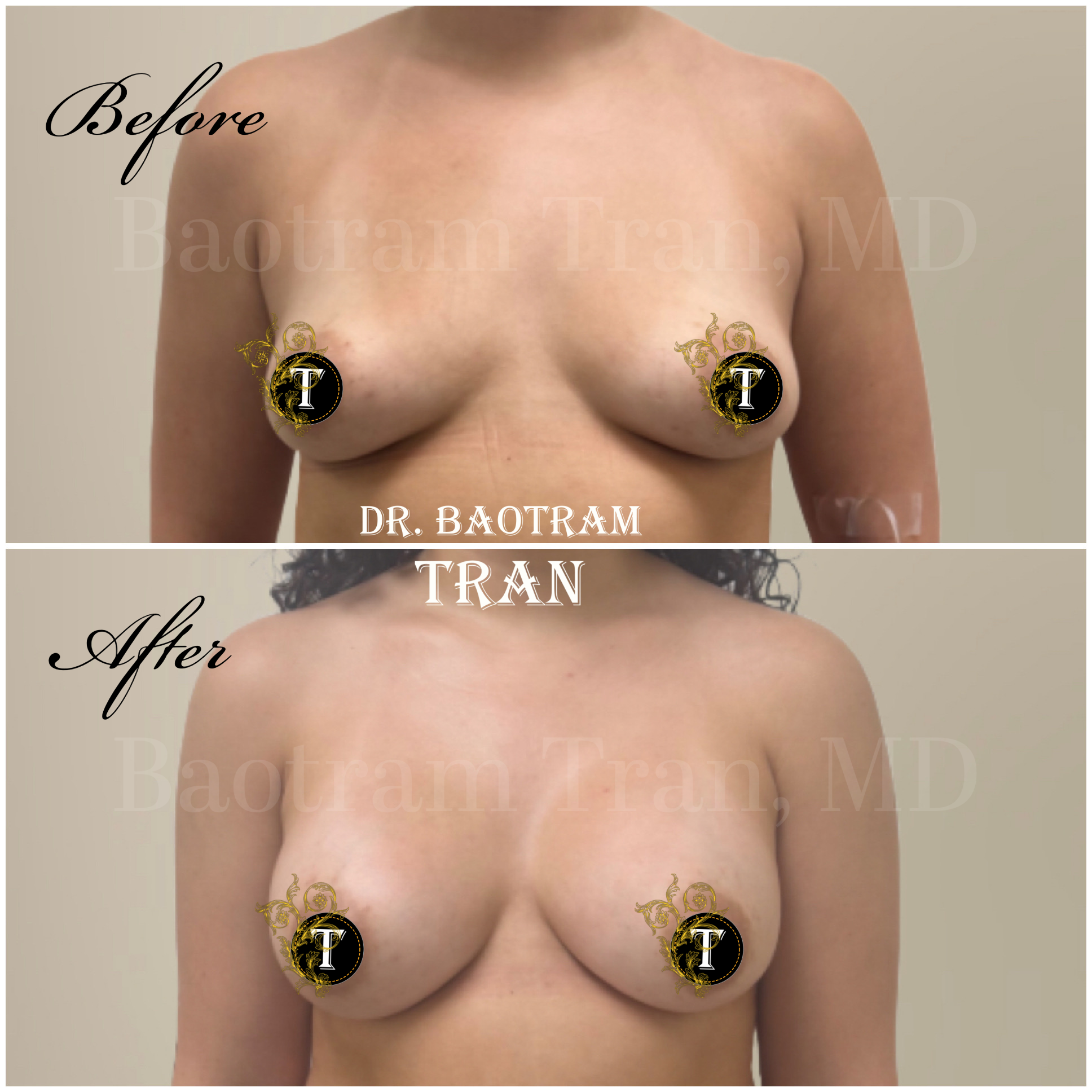 Breast Augmentation by Dr. Victoria Tran — before