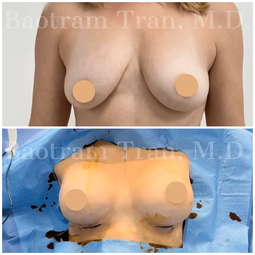 Breast Augmentation by Dr. Victoria Tran — before