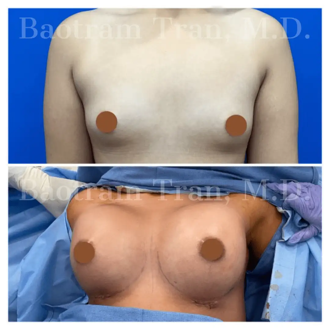 Breast Augmentation by Dr. Victoria Tran — before