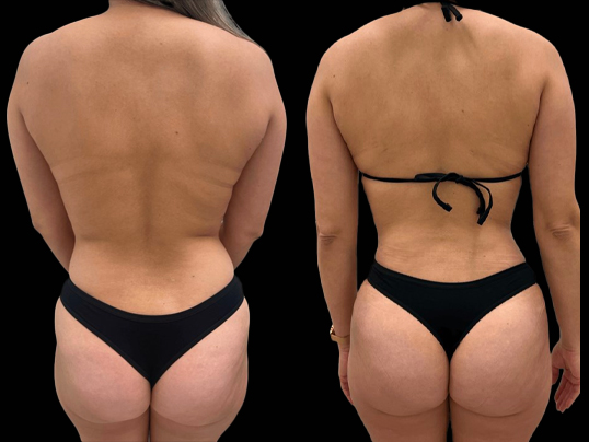 Liposuction before and after - after