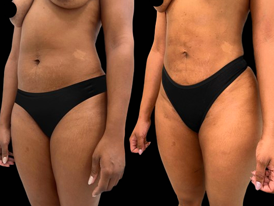 Liposuction before and after - before