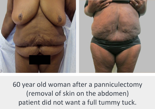 Mommy Makeover before and after - after