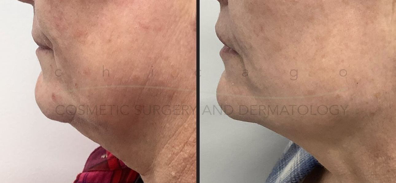 Sofwave before and after - after