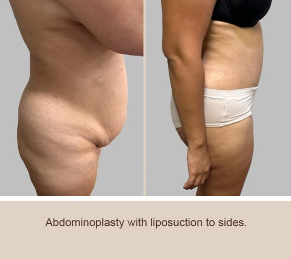 Abdominoplasty (Tummy Tuck) before and after - after
